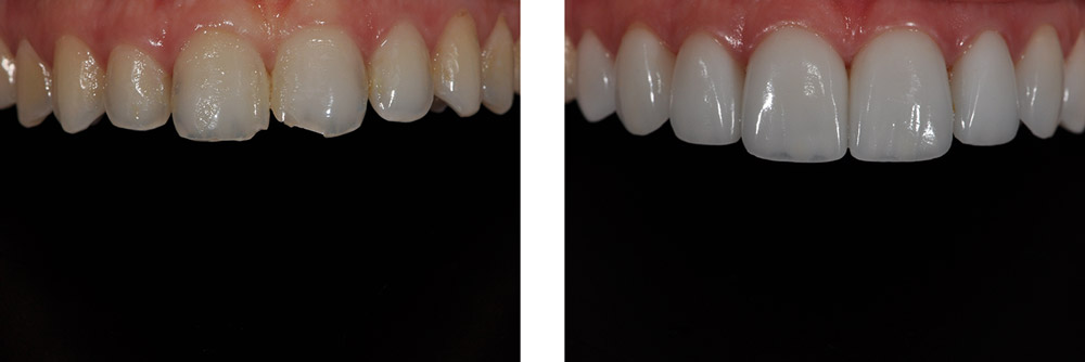 Dental Teeth Bonding
